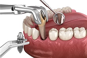بررسی تخصصی مزایا و معایب ایمپلنت فوری از دید دندانپزشکان