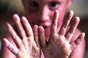 بیماران ای‌بی حق دسترسی به خدمات درمانی ضروری را دارند