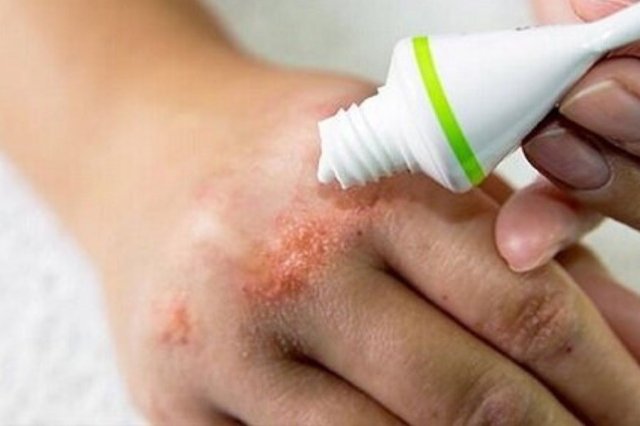 تصویر چگونه از التهاب و کهیر جلوگیری کنیم؟