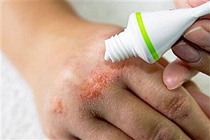 چگونه از التهاب و کهیر جلوگیری کنیم؟