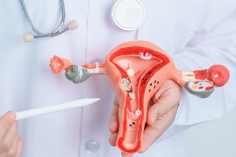 تصویر شیوع آندومتریوز در زنان نابارور تا ۵۰ درصد است