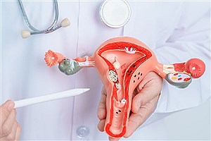 شیوع آندومتریوز در زنان نابارور تا ۵۰ درصد است