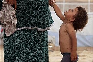 انفجار بیماری‌های پوستی در غزه؛ شمار مبتلایان از ۵۸ هزار نفر گذشت