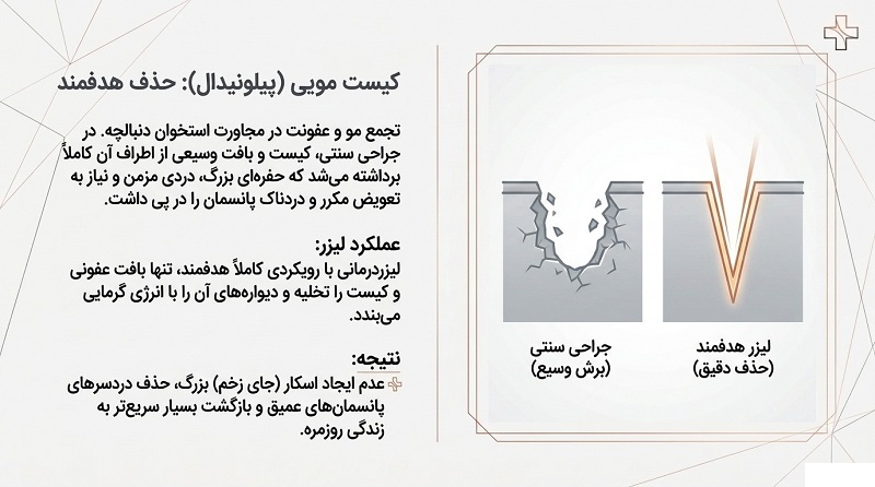 لیزر کیست مویی