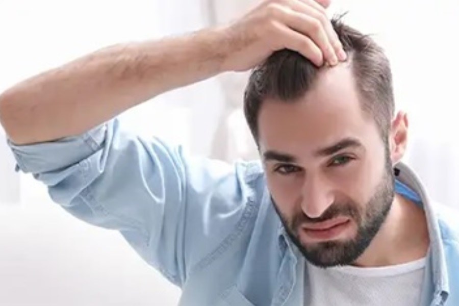 بهترین کاشت مو در ایلام