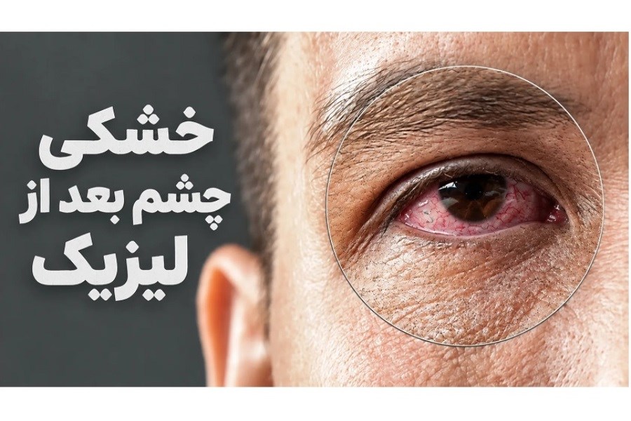 خشکی چشم بعد از لیزیک